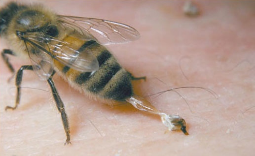 زهر زنبور عسل و روش های زهرگیری از این حشره